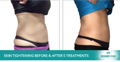 Medspa and Weight Loss Clinic Near Katy, TX – Medshape Texas